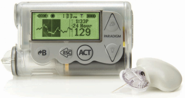 MiniMed 530G System with Elite Sensor by Medtronic